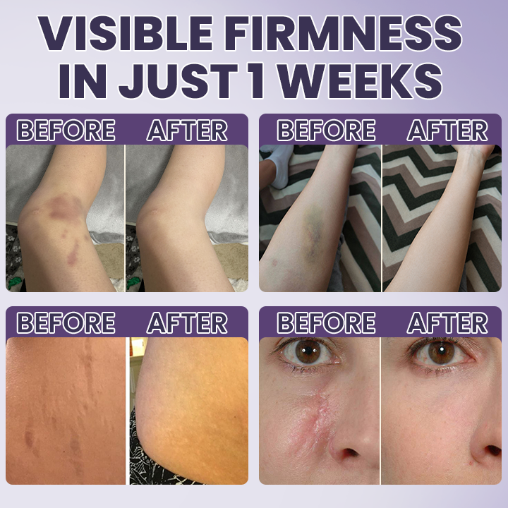 💥100K+ SOLD◻️ 𝐌𝐑𝐄𝐕𝐁𝑺𝑰𝑵® NEW Upgraded Bruise Repair Cream | Skin-Strengthening Formula for Easily Bruised Skin