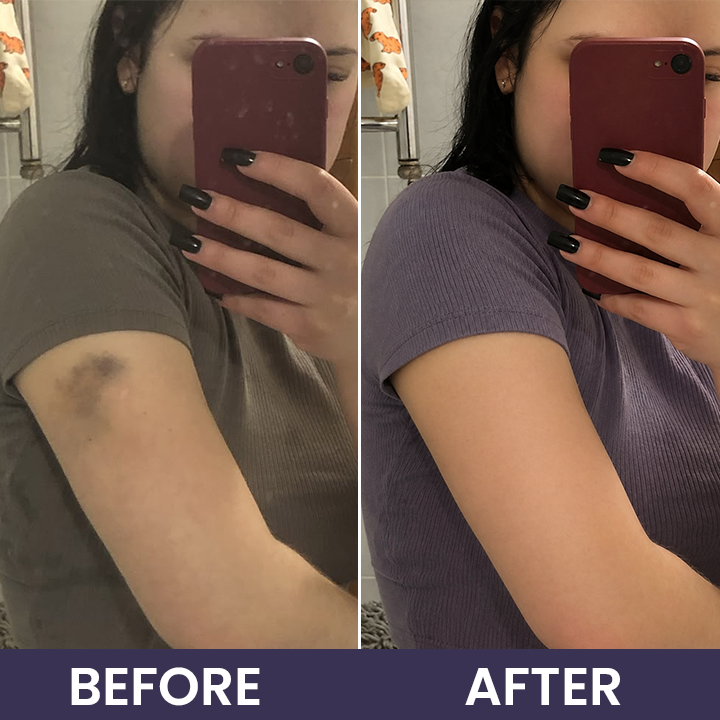 💥100K+ SOLD◻️ 𝐌𝐑𝐄𝐕𝐁𝑺𝑰𝑵® NEW Upgraded Bruise Repair Cream | Skin-Strengthening Formula for Easily Bruised Skin