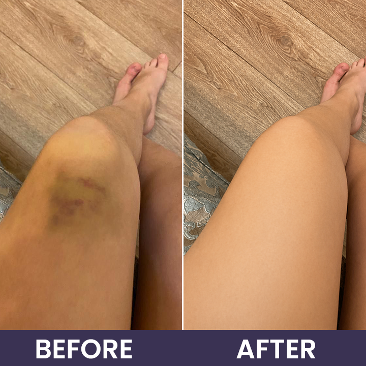 💥100K+ SOLD◻️ 𝐌𝐑𝐄𝐕𝐁𝑺𝑰𝑵® NEW Upgraded Bruise Repair Cream | Skin-Strengthening Formula for Easily Bruised Skin