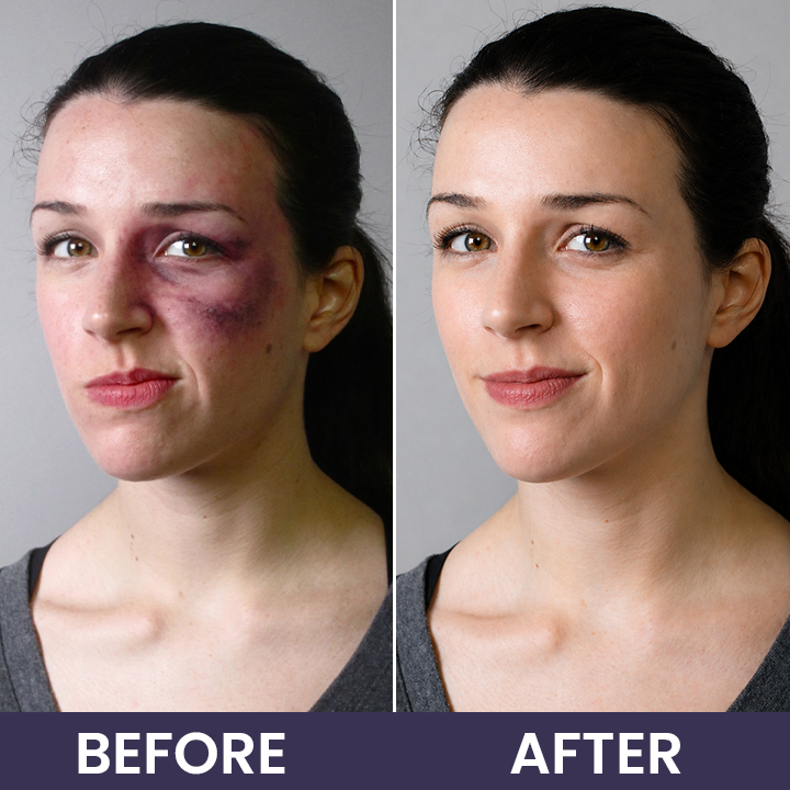 💥100K+ SOLD◻️ 𝐌𝐑𝐄𝐕𝐁𝑺𝑰𝑵® NEW Upgraded Bruise Repair Cream | Skin-Strengthening Formula for Easily Bruised Skin