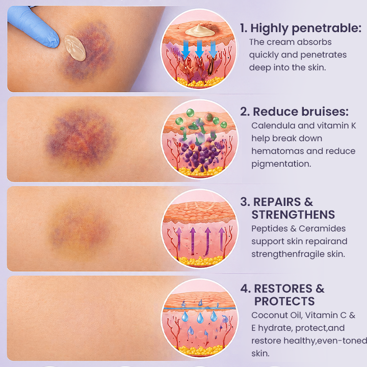 💥100K+ SOLD◻️ 𝐌𝐑𝐄𝐕𝐁𝑺𝑰𝑵® NEW Upgraded Bruise Repair Cream | Skin-Strengthening Formula for Easily Bruised Skin