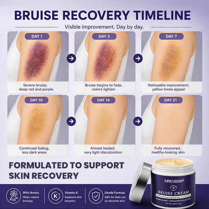 💥100K+ SOLD◻️ 𝐌𝐑𝐄𝐕𝐁𝑺𝑰𝑵® NEW Upgraded Bruise Repair Cream | Skin-Strengthening Formula for Easily Bruised Skin